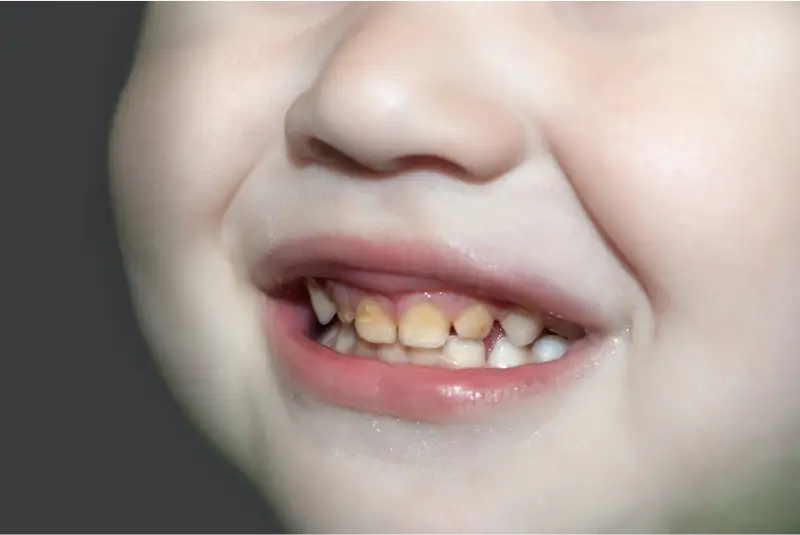 Tooth decay in children Causes, signs and treatment